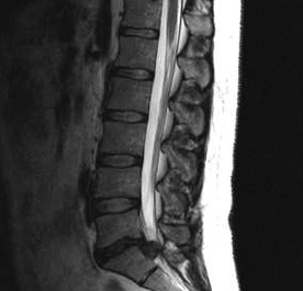 Options de diagnostic pour l'ostéochondose lombaire