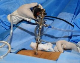 Traitement chirurgical de l'ostéochondose lombaire