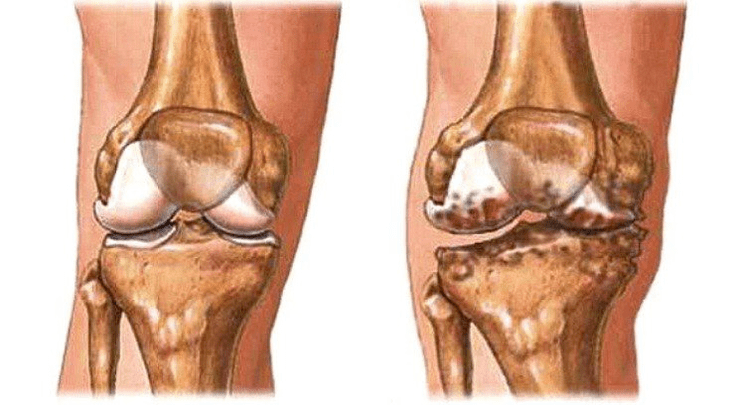 Articulation saine et arthrose de l'articulation du genou