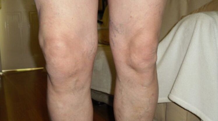 Manifestations de l'arthrose de l'articulation du genou